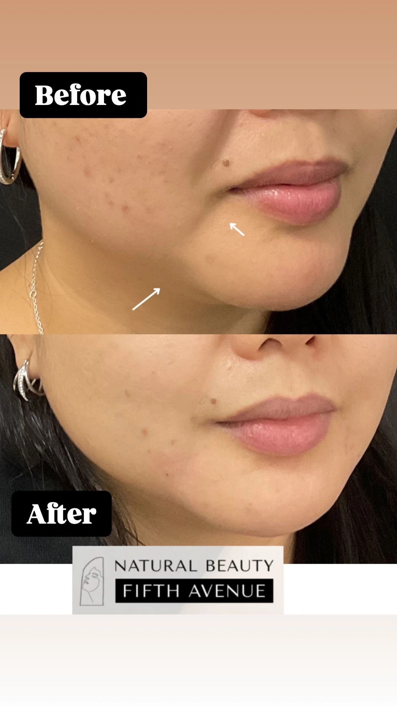Before and after K Luxe Tightlift treatment showing improved jawline definition and skin tightness